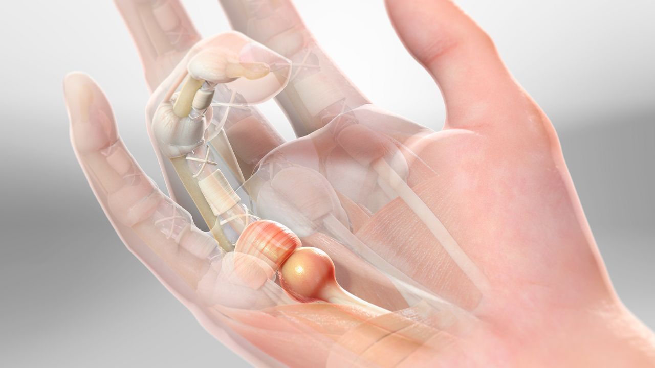 Hip Fracture